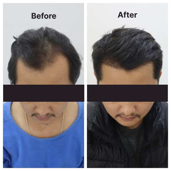 Hair Transplant result KOQ10